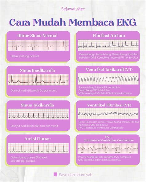 Serangan Jantung EKG: Mengenal dan Mencegahnya